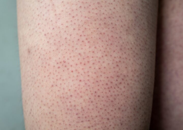 Dày sừng nang lông: Nguyên nhân & Điều trị