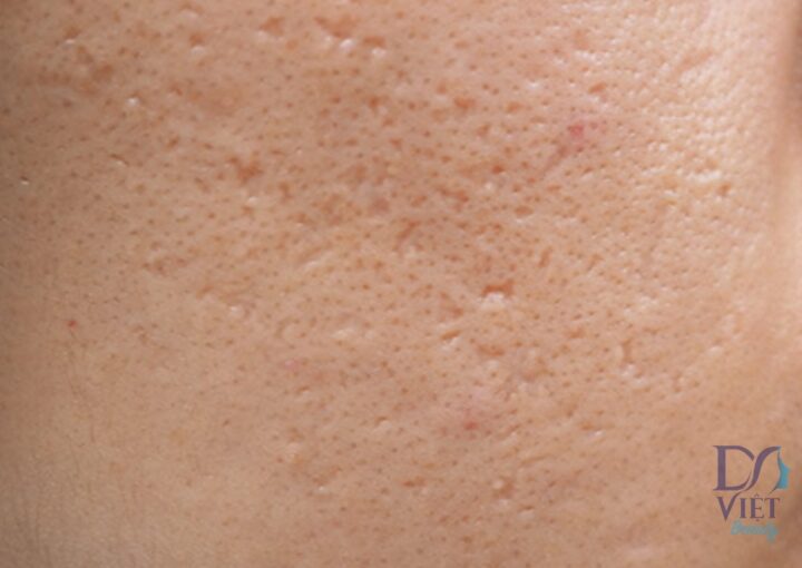 Làm sao phân biệt Sẹo đáy nhọn và Lỗ chân lông to