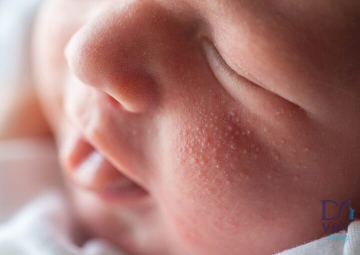 Rôm Sảy Có Nguy Hiểm Không? Tác Hại Và Cách Xử Lý