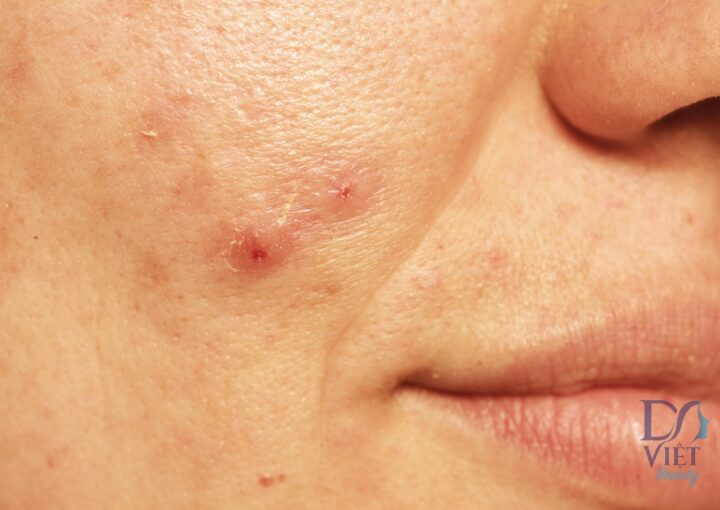 Sẹo lồi sau mụn: Bí quyết ngăn ngừa và điều trị