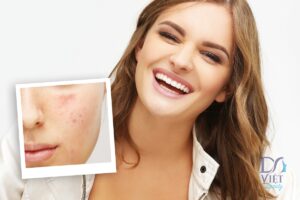 Retinoid có thực sự mang lại hiệu quả trong điều trị sẹo mụn?