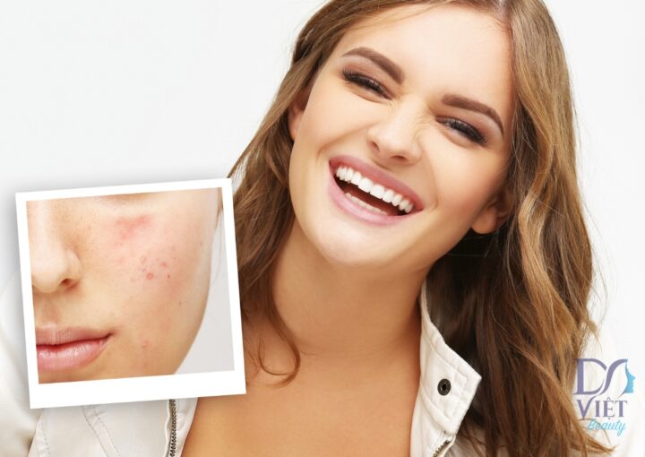 Retinoid có thực sự mang lại hiệu quả trong điều trị sẹo mụn?