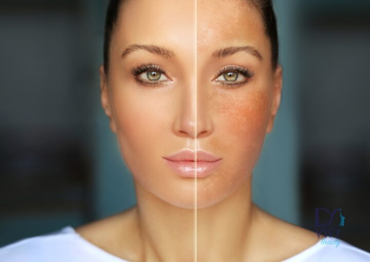 Tăng sắc tố da sau viêm là gì? Cách điều trị ra sao?