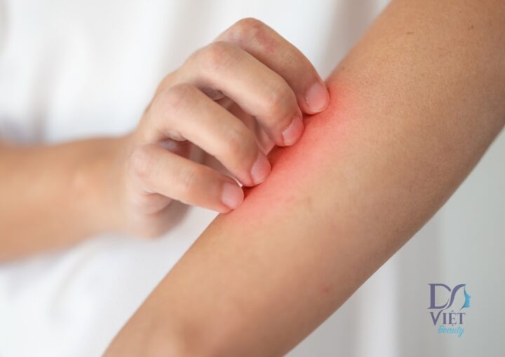 Viêm Da Do Nhện Cắn: Nguyên Nhân, Triệu Chứng và Phòng Tránh