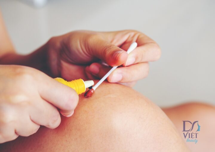 Cách chăm sóc vết thương hở