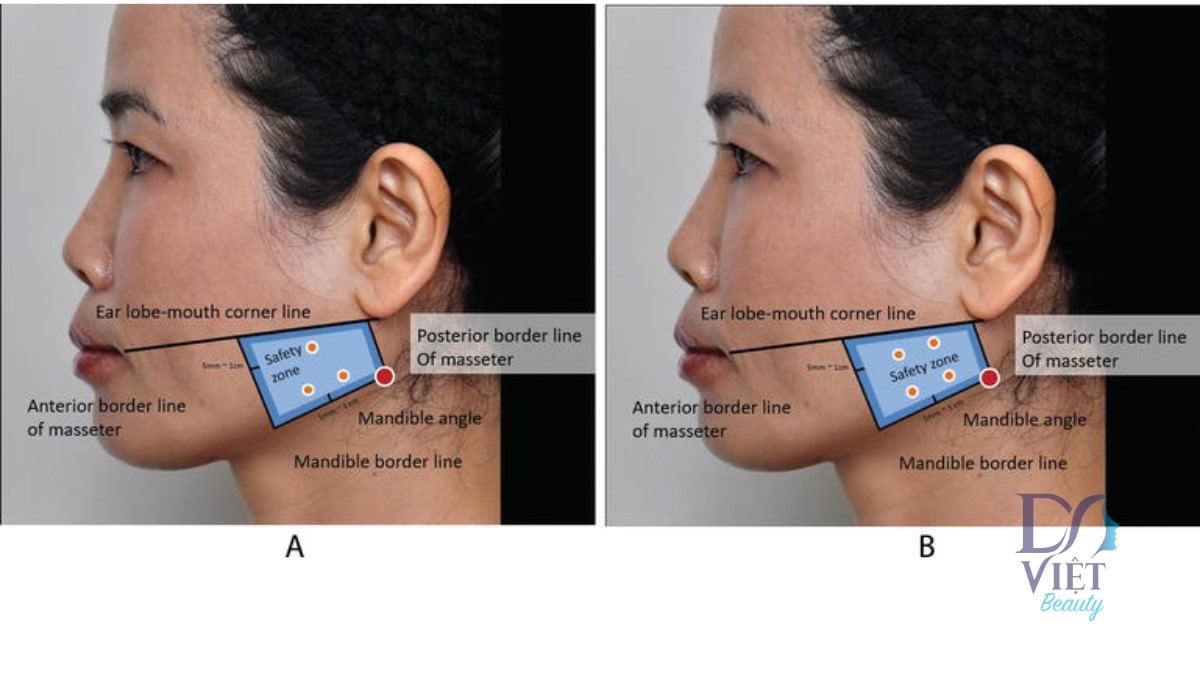 Tránh nụ cười mất cân đối sau khi tiêm toxin cơ cắn