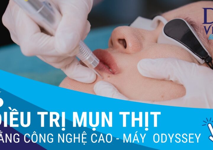 Điều trị MỤN THỊT tại DA VIỆT BEAUTY bằng công nghệ cao, máy ODYSSEY