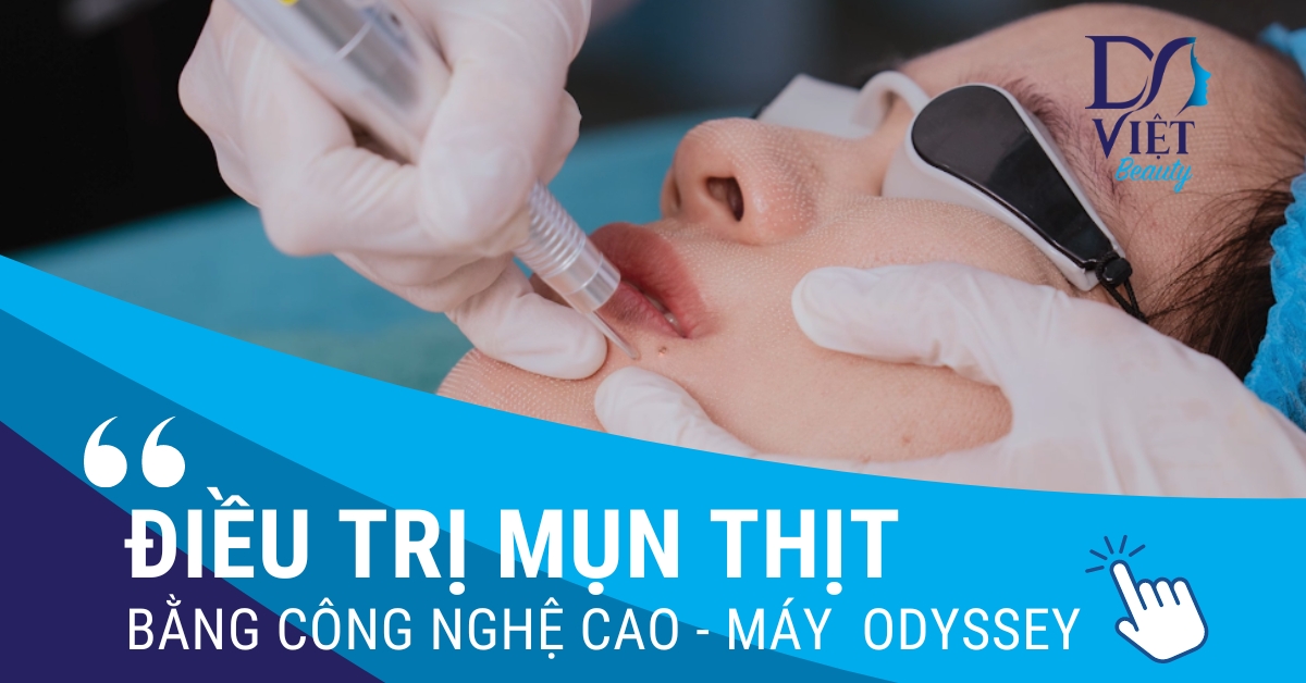 Điều trị MỤN THỊT tại DA VIỆT BEAUTY bằng công nghệ cao, máy ODYSSEY