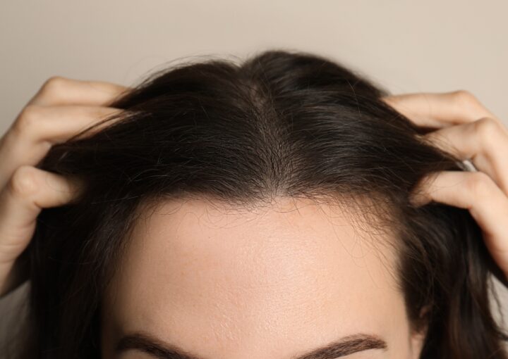 Hói đầu ở nữ - Cách điều trị & phòng ngừa hiệu quả?