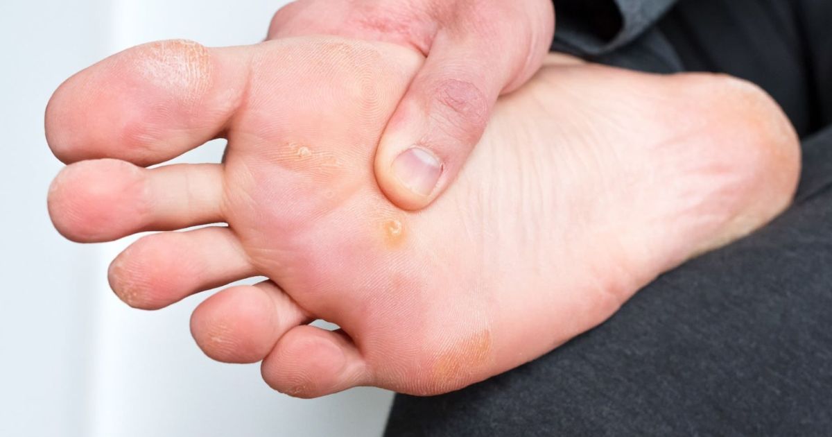 Các loại mụn cóc 