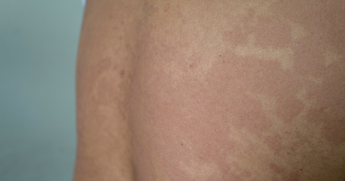 Dấu hiệu nhận biết lang ben đỏ