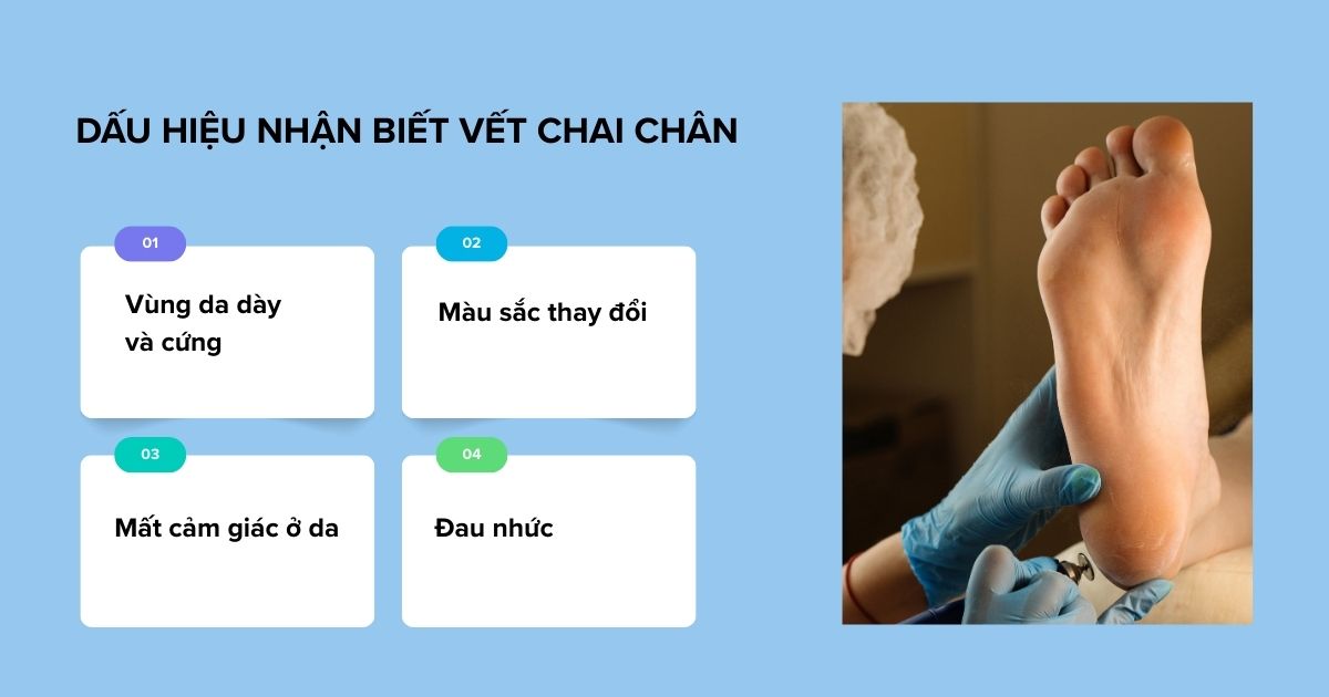dấu hiệu nhận biết vết chai chân