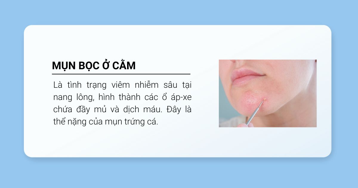 mụn bọc ở cằm là gì