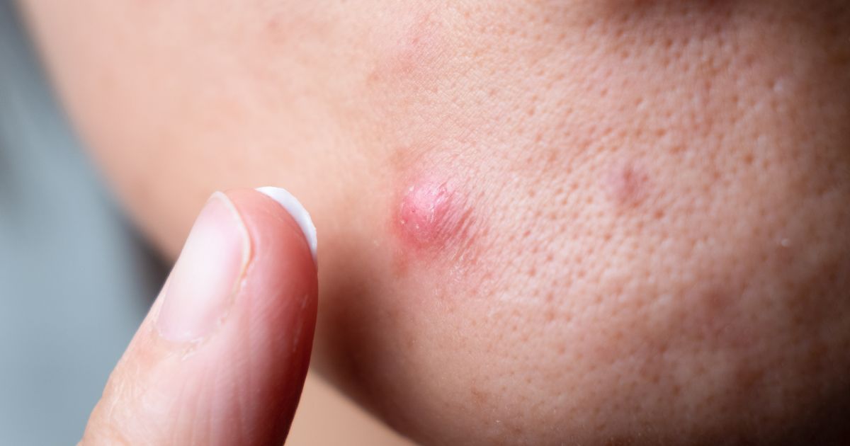 dấu hiệu nhận biết mụn boc 