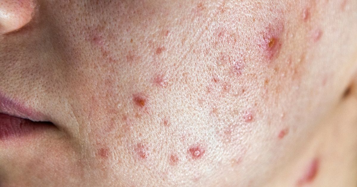 Nguyên nhân gây mụn ở má