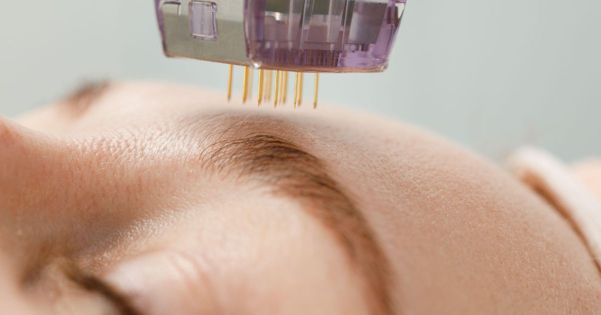 điều trị nám chân sâu 