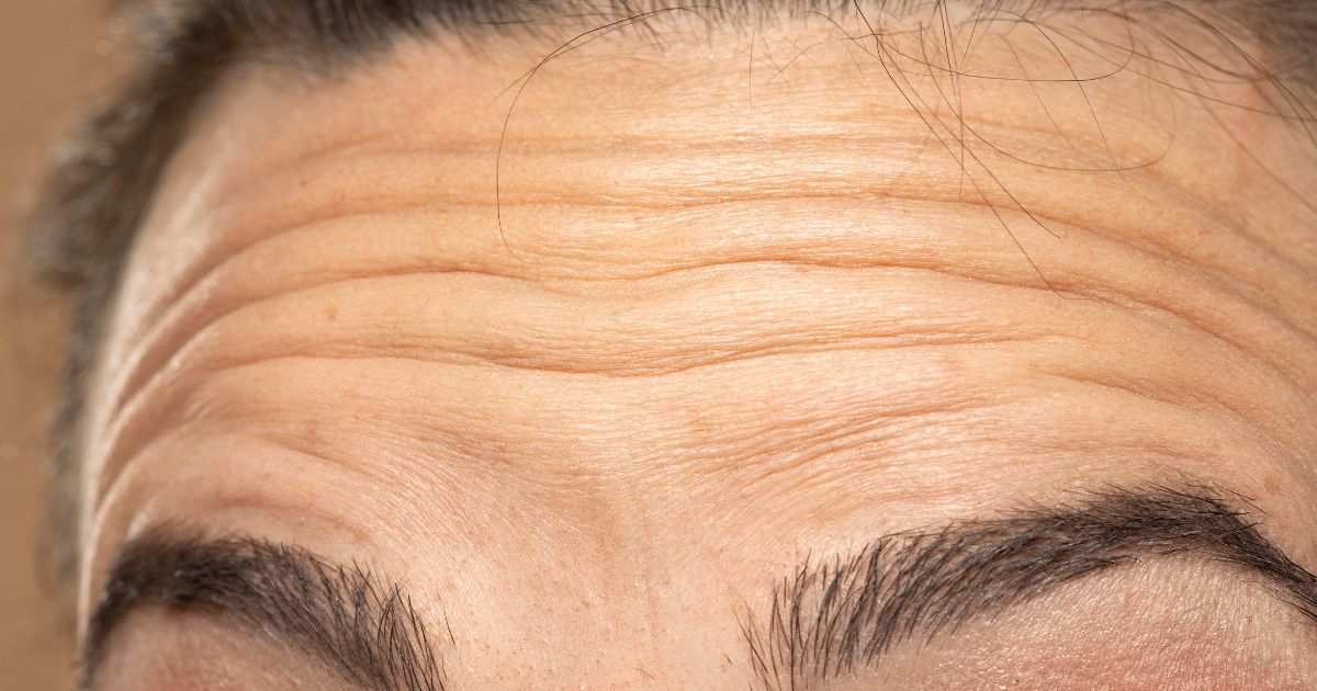 Dấu hiệu của nếp nhăn trên trán 