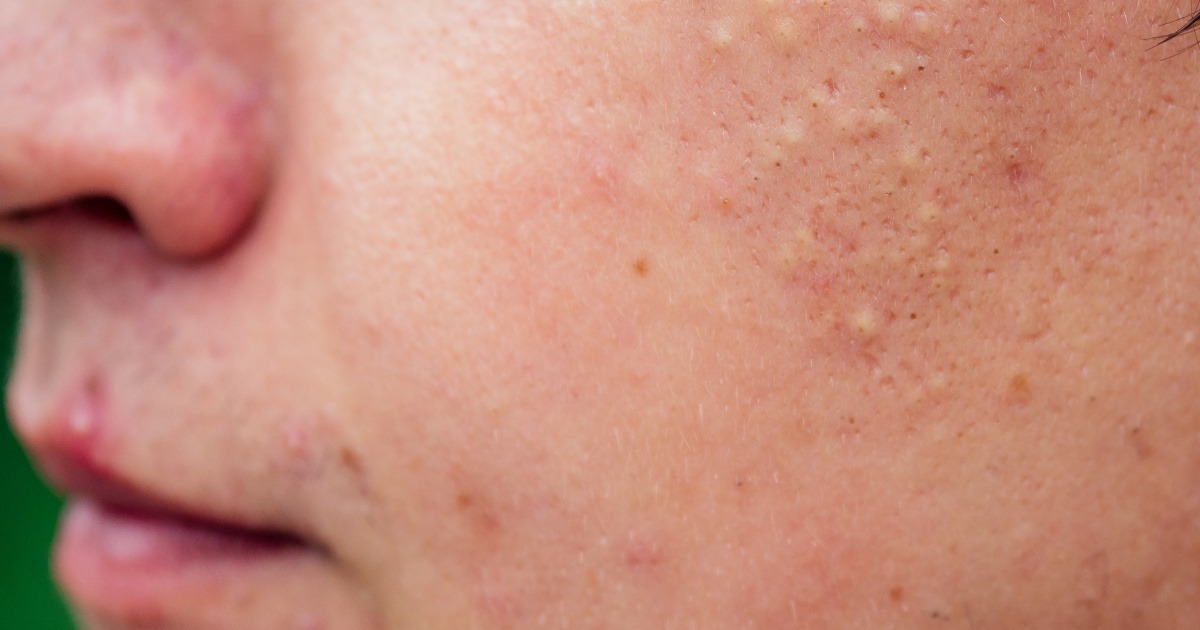 Nguyên nhân da khô thiếu chất 