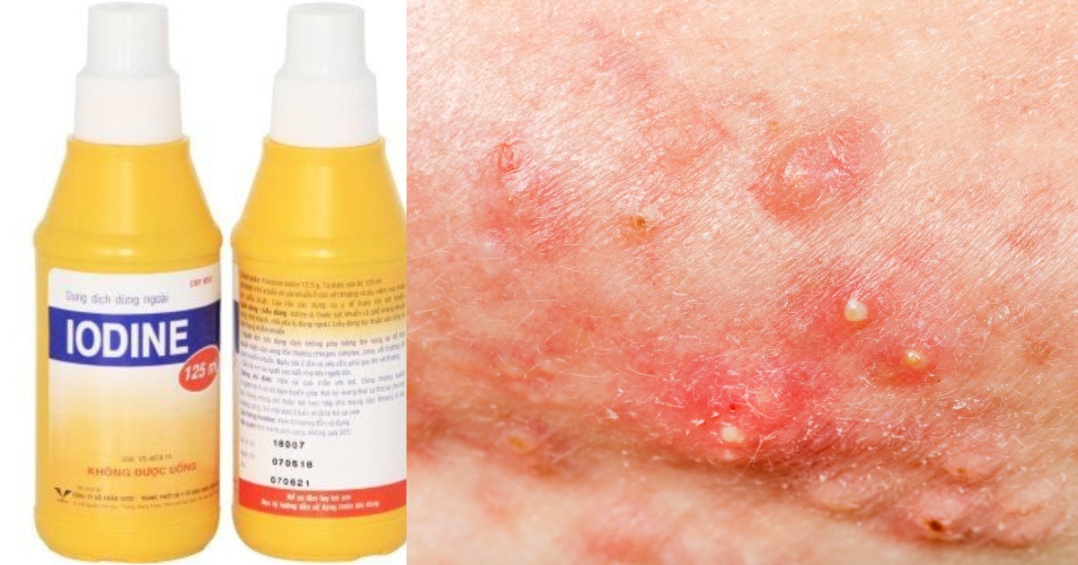 Cách trị mụn nhọt ở mông nhanh chóng