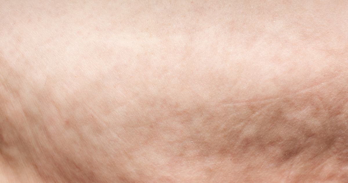 Vị trí tường hay xuất hiện da sần vỏ cam 