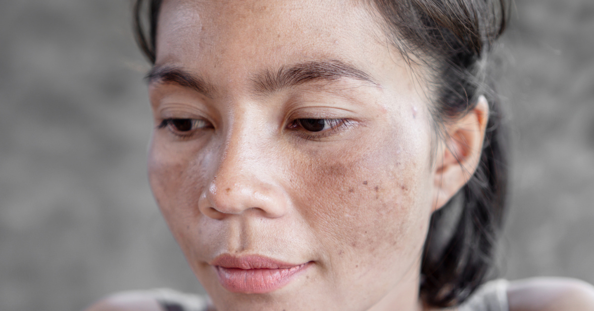 7 Nguyên nhân da nổi đốm nâu không ngứa