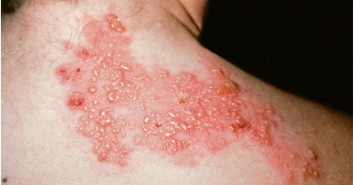 Zona thần kinh gây chùm mụn nước đỏ dọc dây thần kinh một bên cơ thể, kèm đau rát dữ dội.