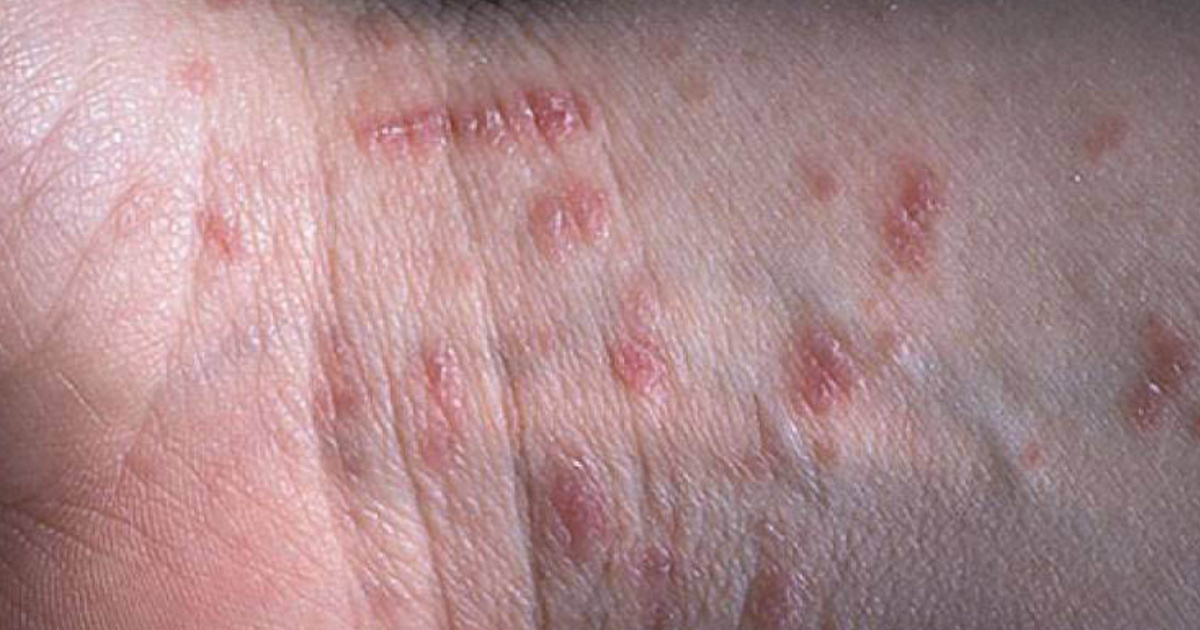 Biến chứng của ghẻ nước ở chân nếu không điều trị