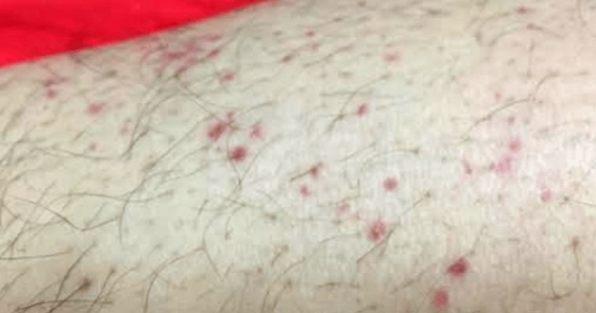 Các loại chấm đỏ trên da thường gặp