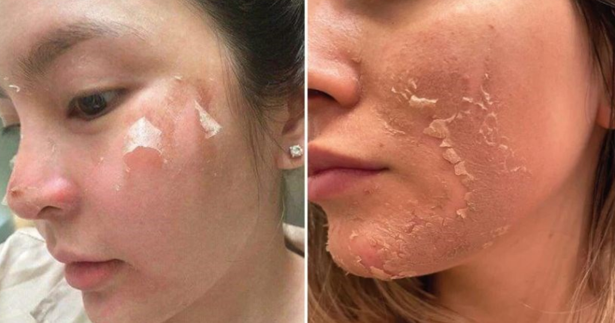 Các phương pháp điều trị da mặt sần sùi