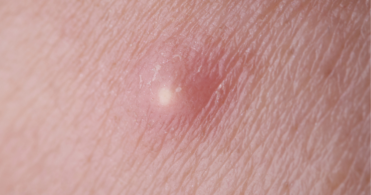 Cách xử lý mụn nhọt ở chân tại nhà an toàn