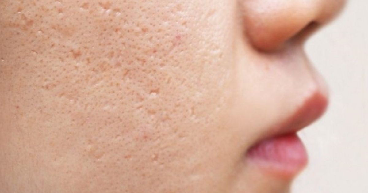 Dấu hiệu da mặt sần sùi