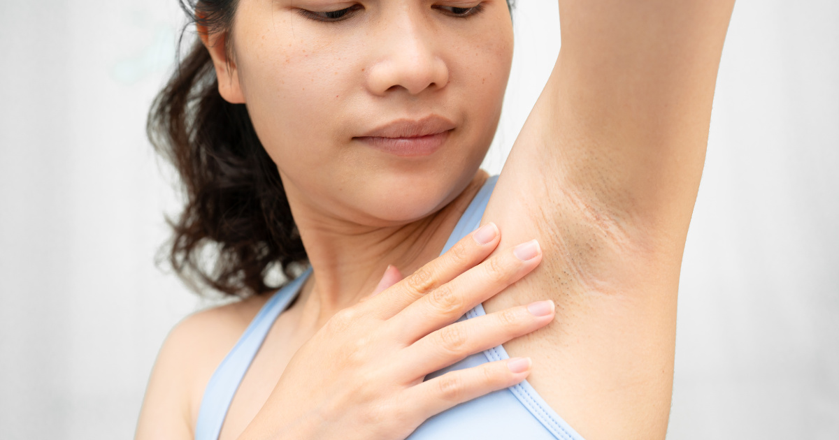 Peel da trị thâm, sần nách hiệu quả nhưng cần bác sĩ chỉ định phác đồ theo tình trạng da thực tế.