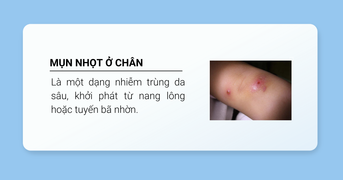 mụn nhọt ở chân 