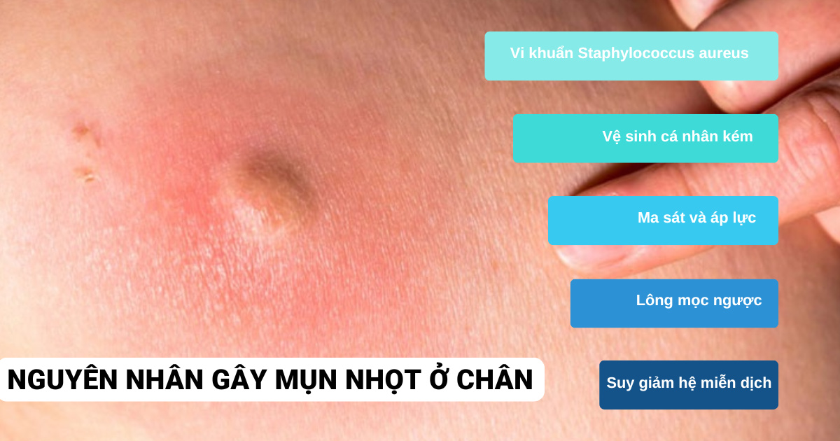 Mụn nhọt ở chân do vi khuẩn xâm nhập và phát triển quá mức ngay tại các nang lông.